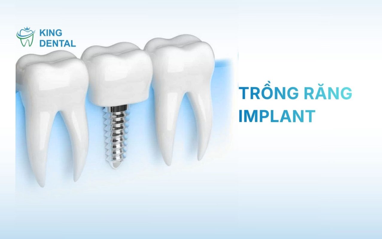 Trồng răng Implant