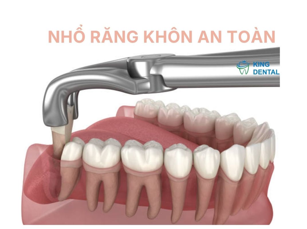 Nhổ răng khôn an toàn