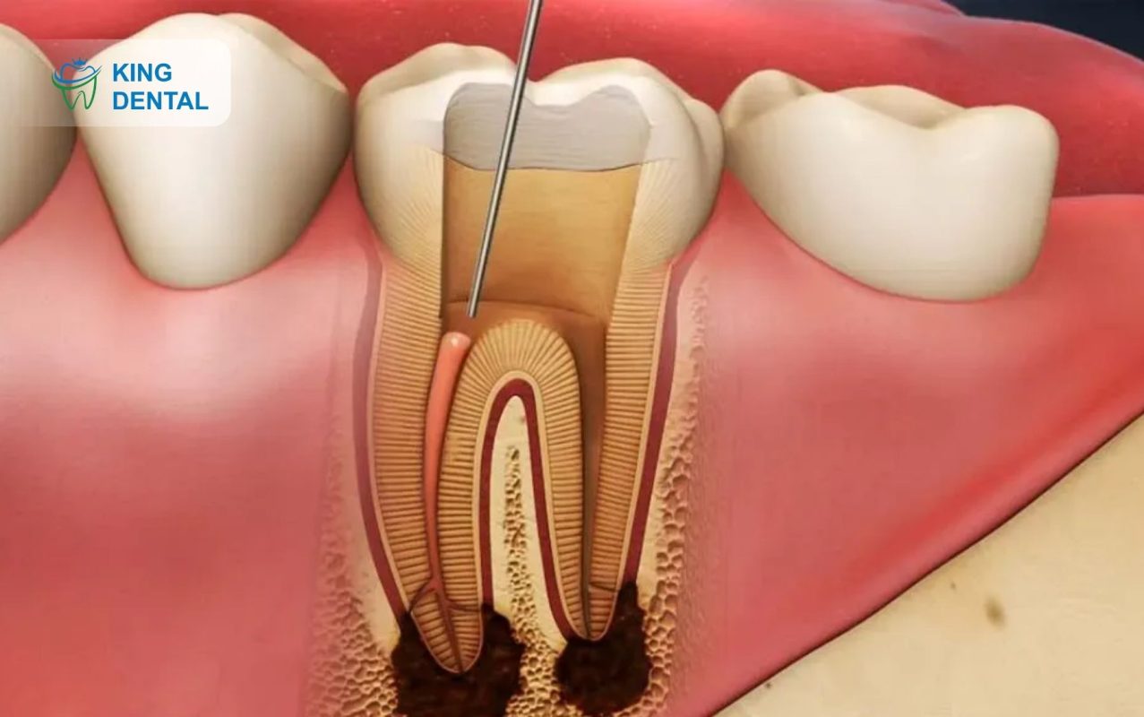 Nguyên nhân nhiễm trùng sau nhổ khôn