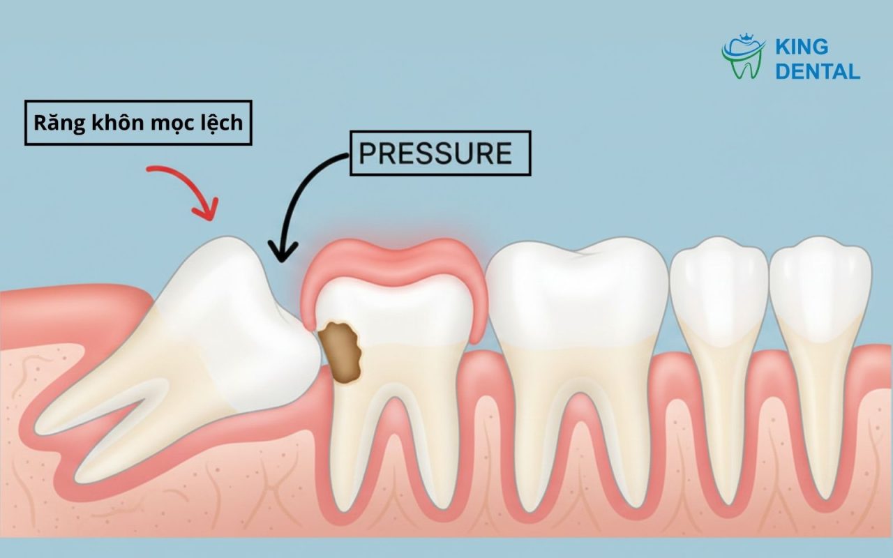 Nguyên nhân nhổ răng khôn đau