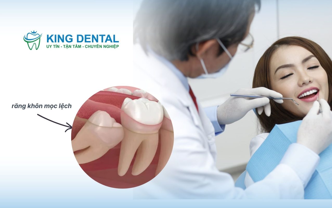 Nhổ răng khôn mọc lệch