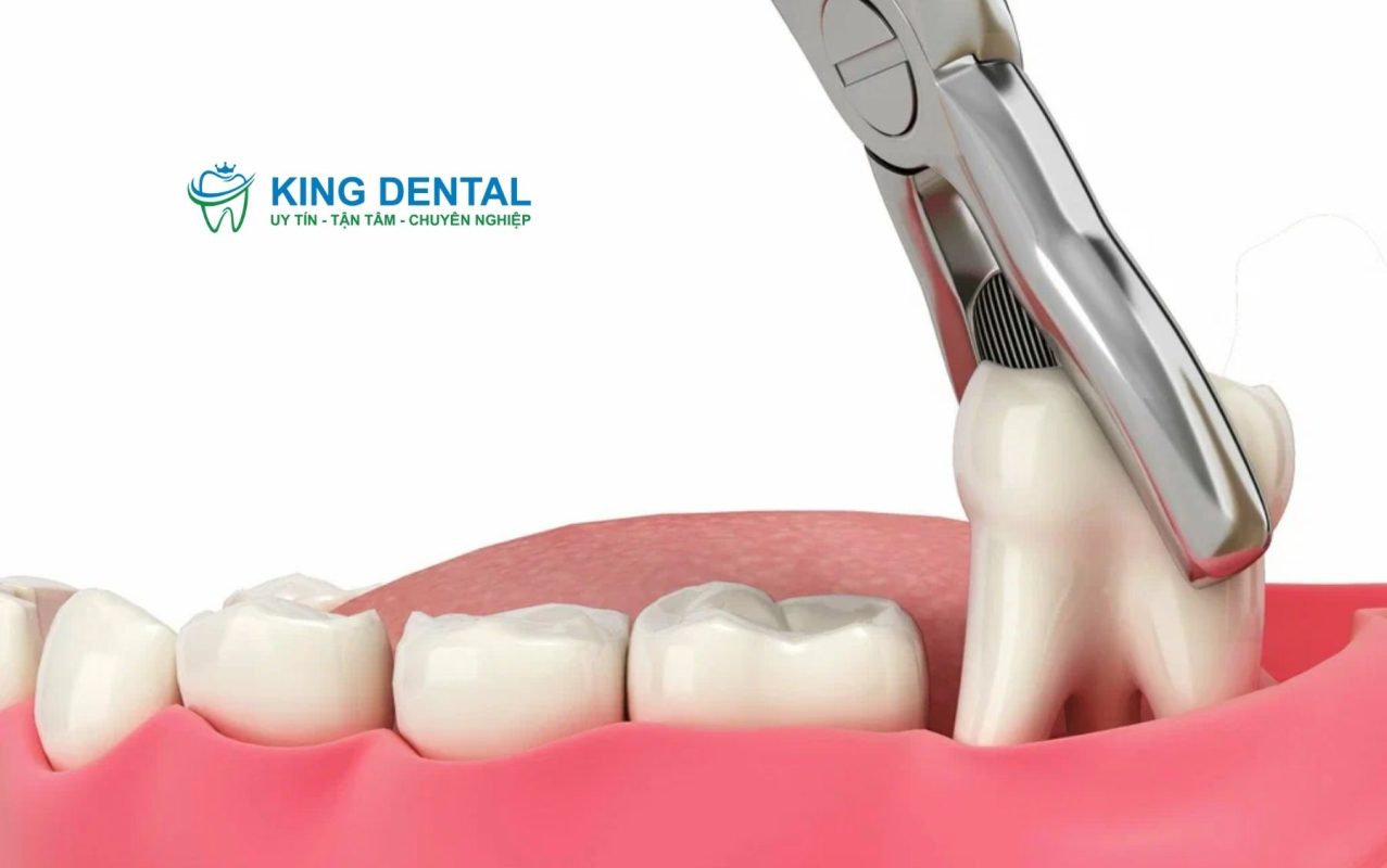 Quy trình nhổ răng khôn