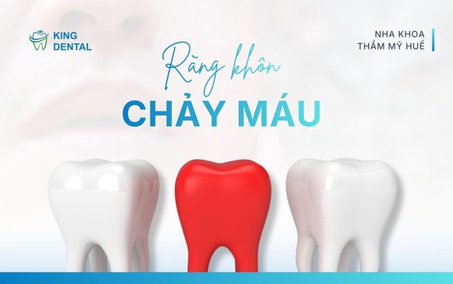 Răng khôn chảy máu