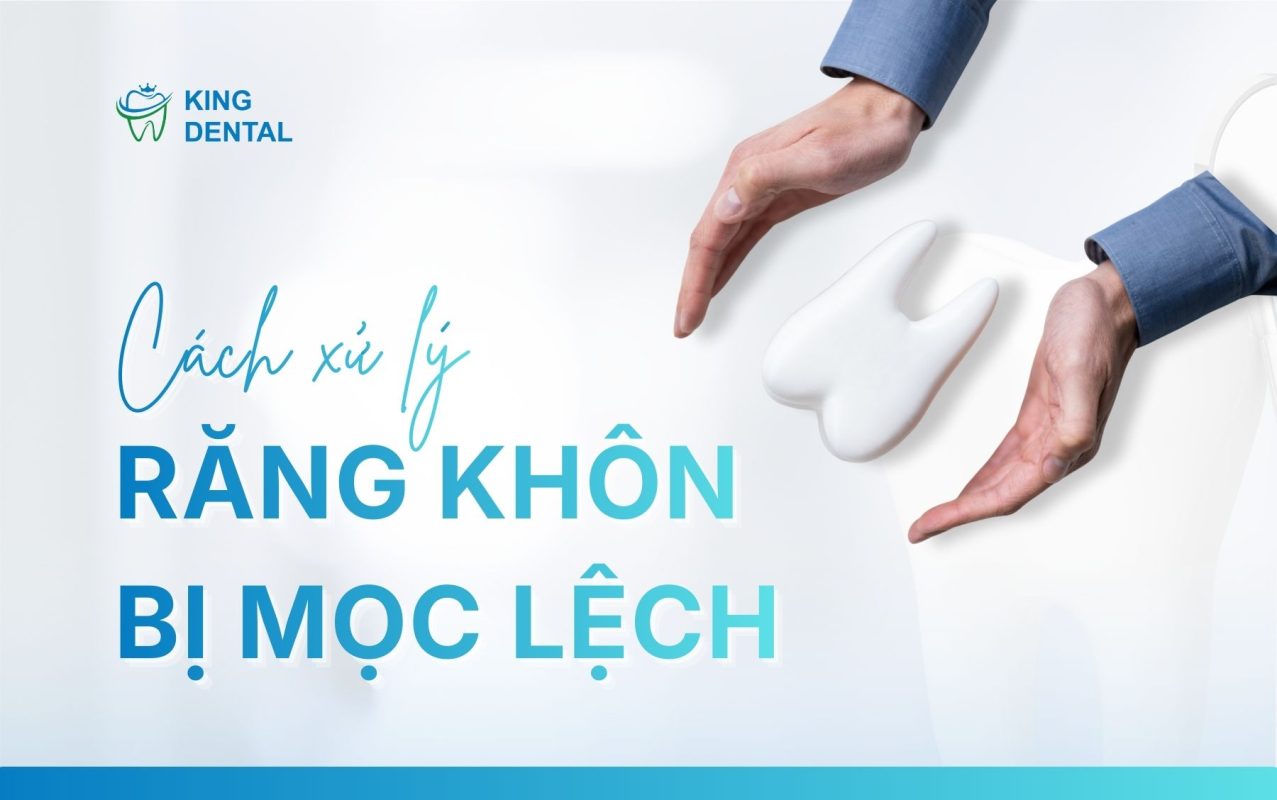 Cách xử lý răng khôn mọc lệch