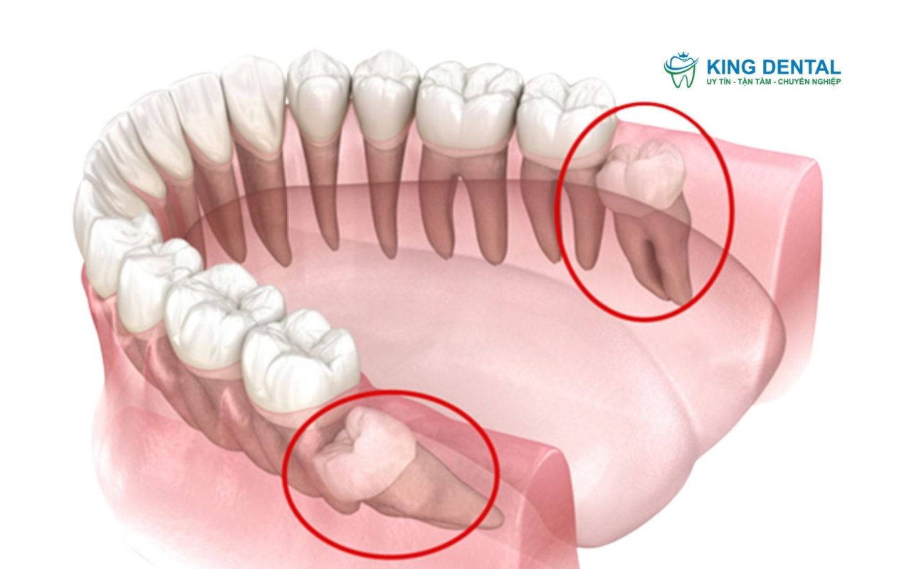 Răng khôn mọc lệch
