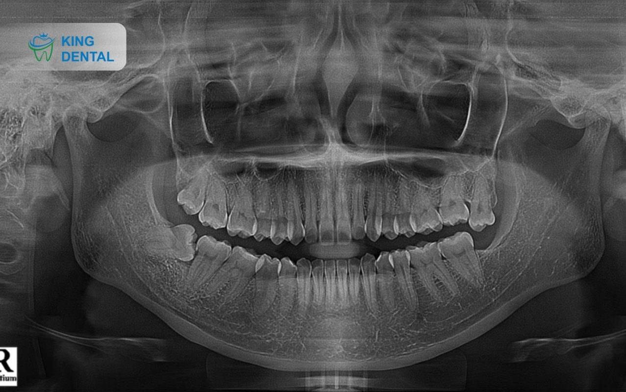 Chụp X-quang răng khôn
