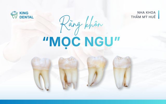 Răng khôn mọc ngu