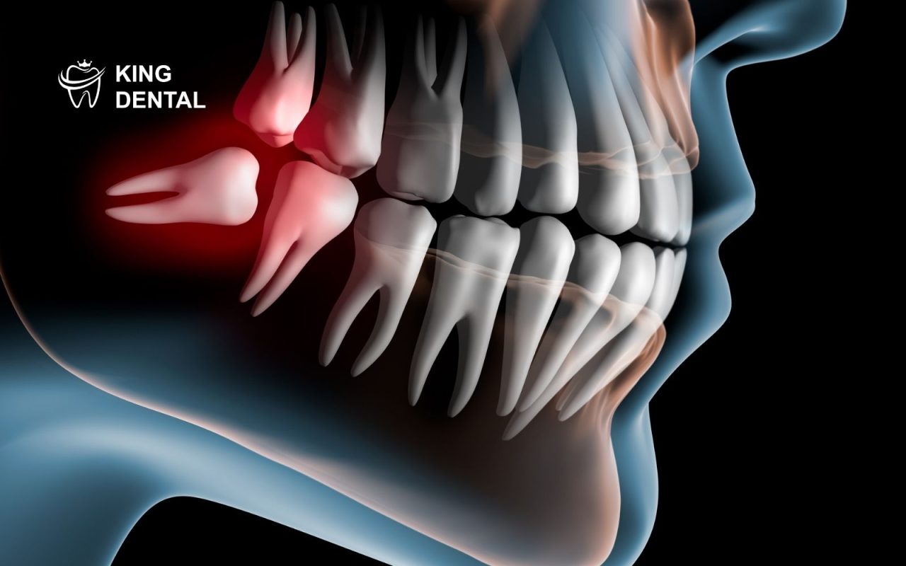 dấu hiệu mọc răng khôn