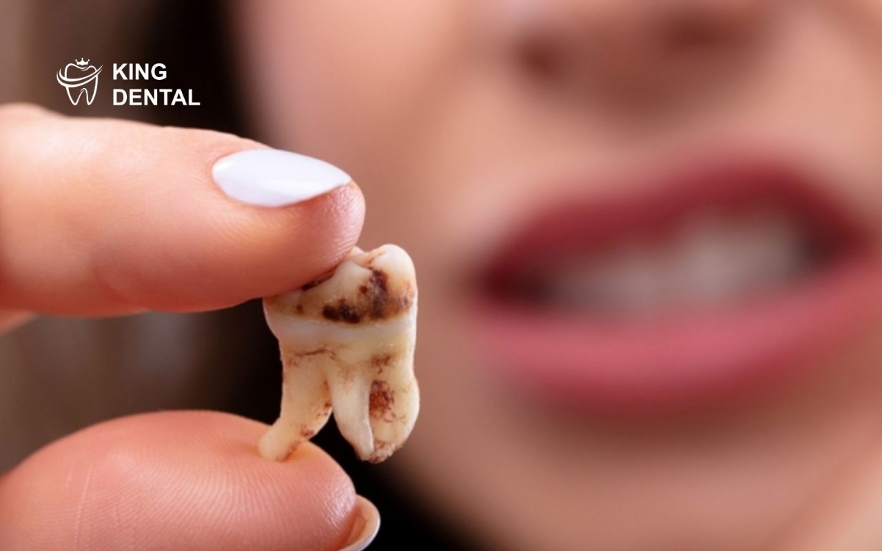 dấu hiệu mọc răng khôn