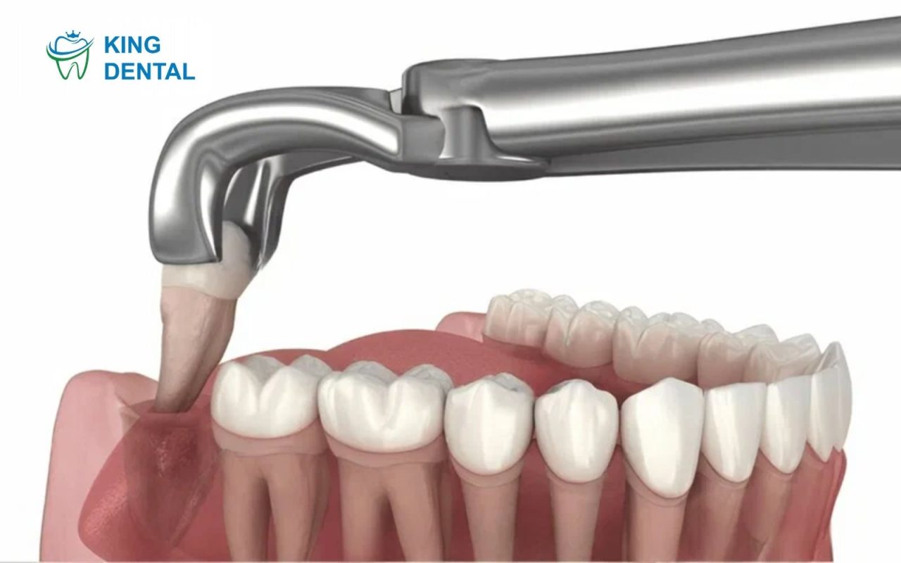 Lưu ý sau nhổ răng khôn