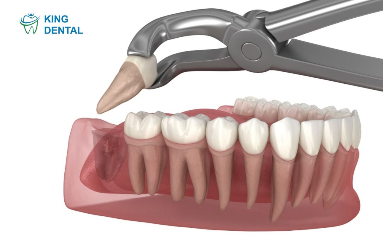 nhổ răng khôn hàm dưới