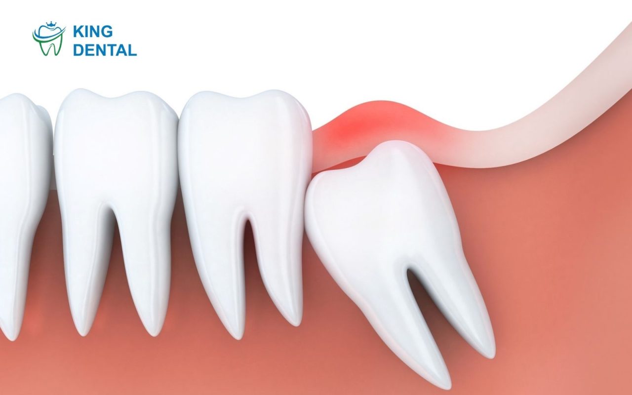 răng khôn hàm dưới 