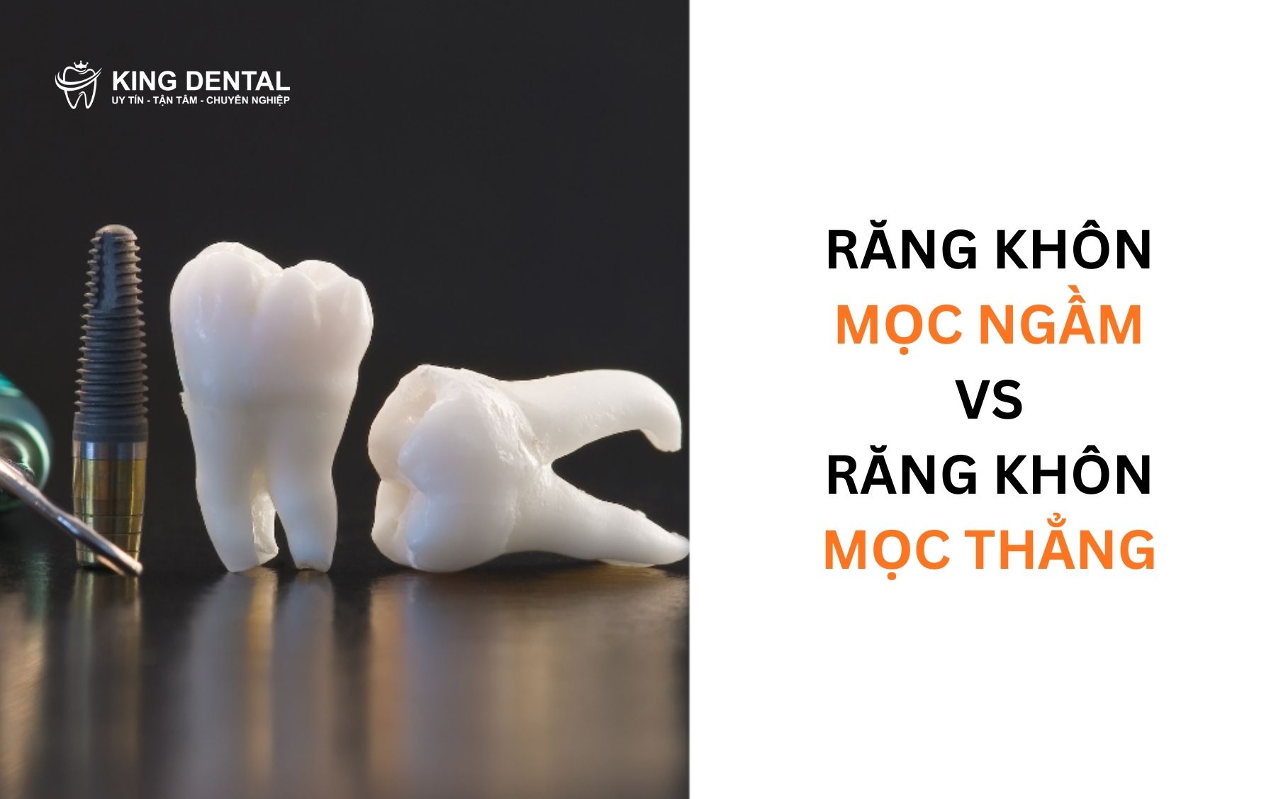 So sánh răng khôn mọc thẳng và răng khôn mọc ngầm